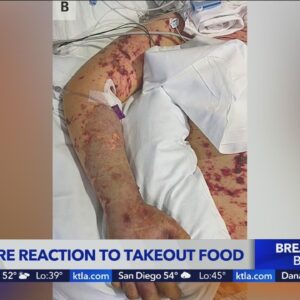 Man has feet, fingers amputated after bad Chinese leftovers