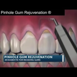 Pinhole Gum Rejuvenation an easier fix for receding gums