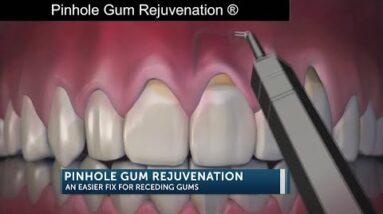 Pinhole Gum Rejuvenation an easier fix for receding gums