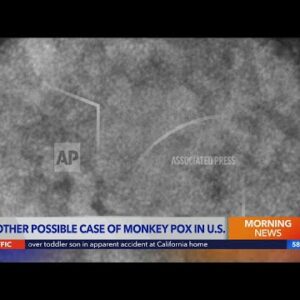 Another possible case of Monkeypox found in U.S.