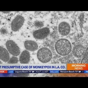 L.A. County confirms 1st presumptive case of monkeypox