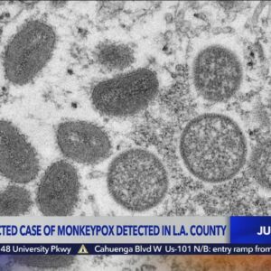 L.A. County confirms 2nd presumptive case of monkeypox