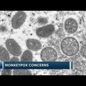 Local experts discuss monkeypox concerns on Central Coast