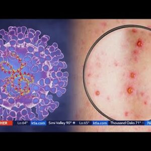 Officials work to raise monkeypox awareness