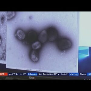 WeHo man discusses his experience with monkeypox