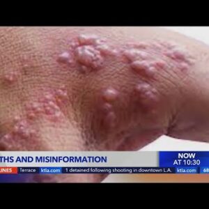Debunking myths and misinformation surrounding Monkeypox
