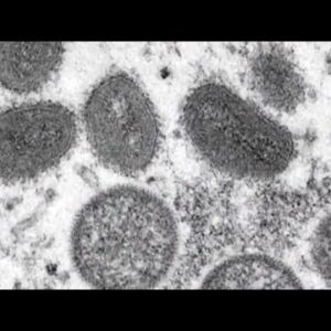 Gov. Gavin Newsom declares state of emergency for Monkeypox