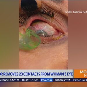 O.C. eye doctor removes 23 contacts from woman’s eye