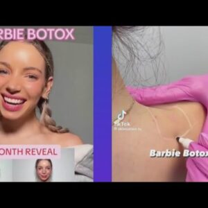 Influencer slammed for promoting 'Barbie Botox' trend