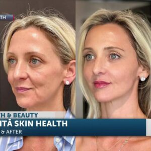 Polly Dursum drops by the Morning News to tell us about her skin care clinic Mudita Skin ...