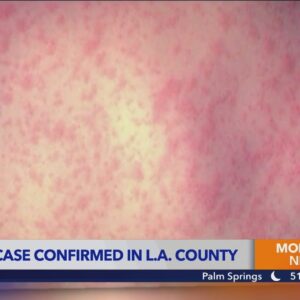 Measles detected in Los Angeles County