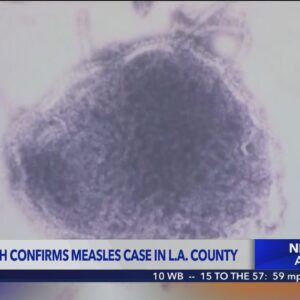 Measles detected in Los Angeles County