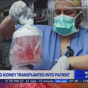 US surgeons transplant a gene-edited pig kidney into a patient for the first time